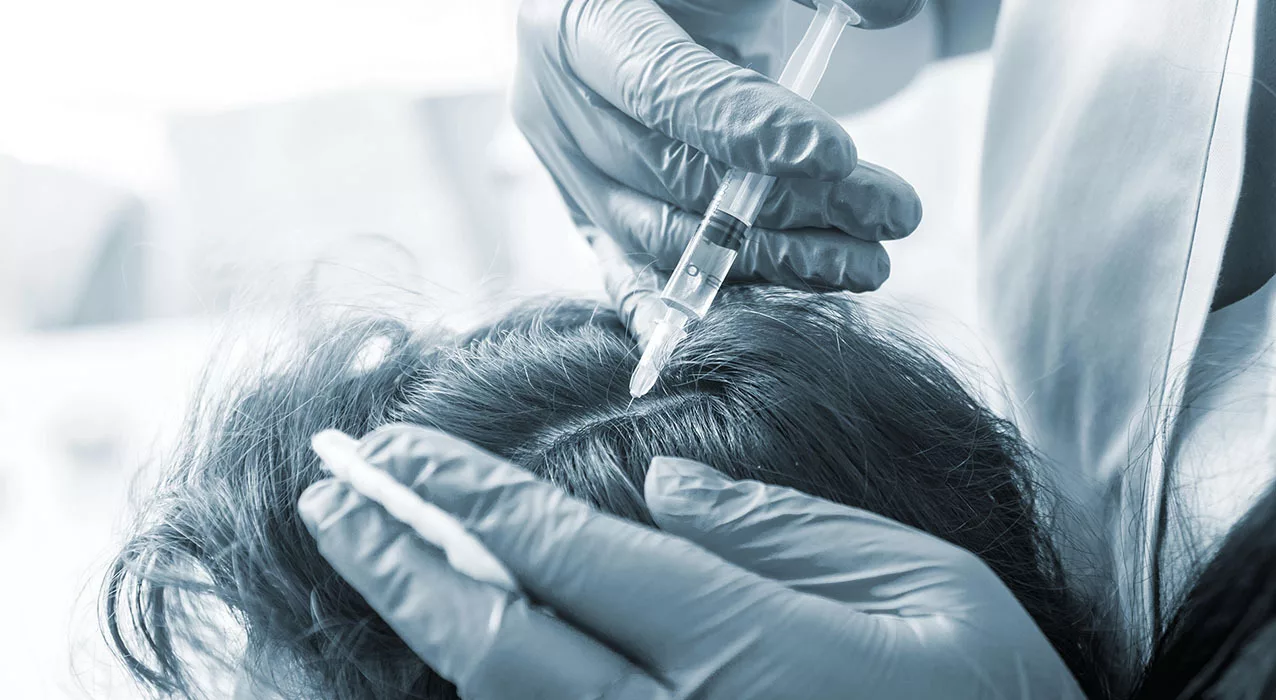 Stem Cell Therapy for Hair Loss